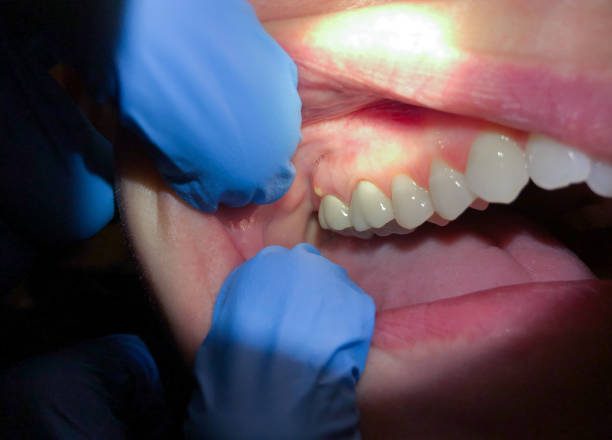 Best Emergency Care for Gum Disease in Winfield, IA